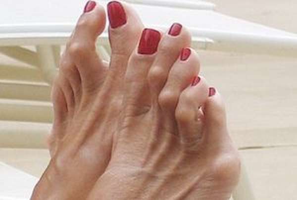 Молоткообразные пальцы на ногах